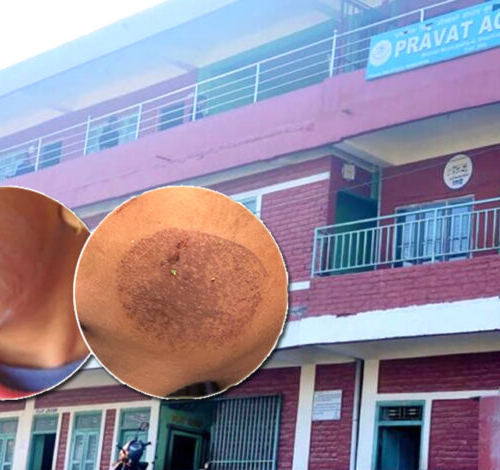 पन्यूले विद्यार्थीको गाला डाम्ने शिक्षिका धरौटीमा रिहा